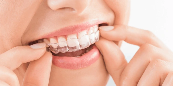 Tratamiento de ortodoncia invisible